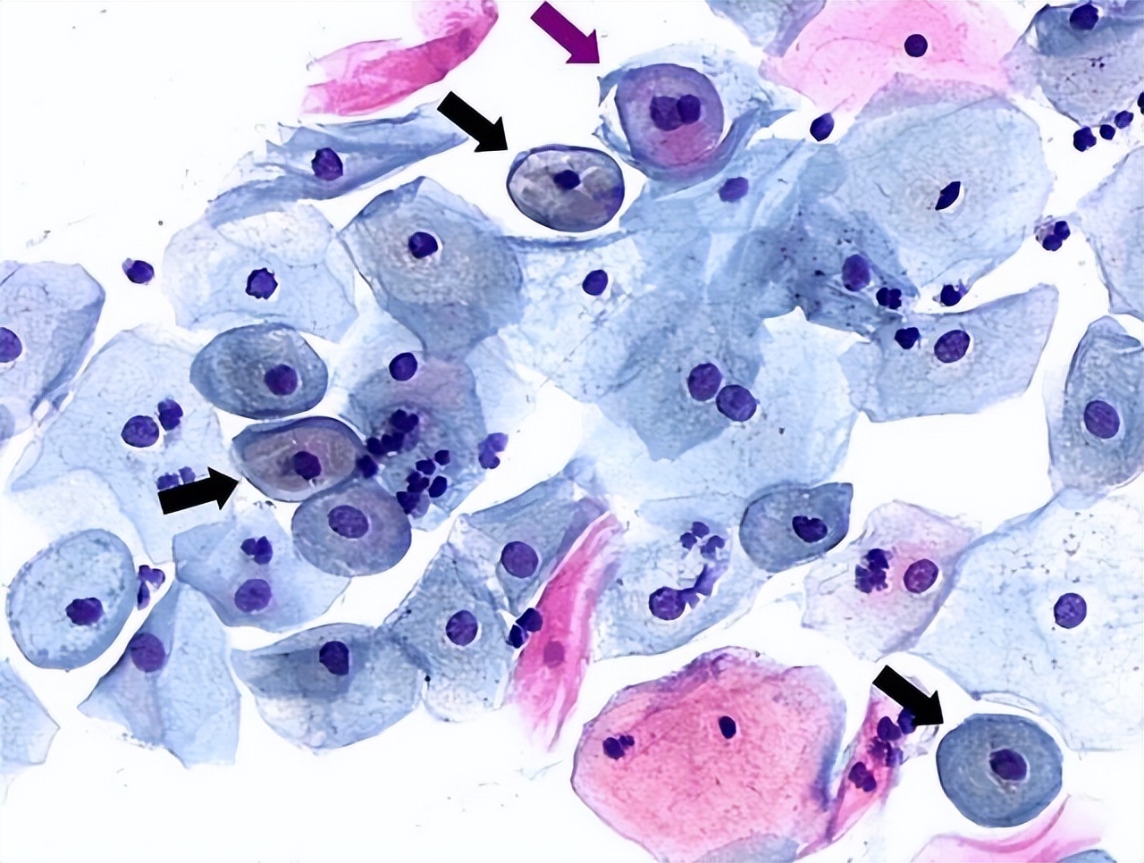 tct炎症性细胞改变轻度严重吗,宫颈tct检查有轻度炎症怎么办