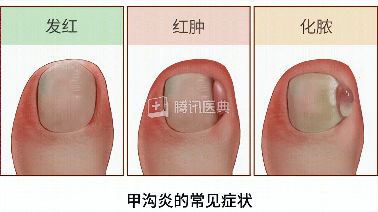 指甲长进肉里,手指甲长进肉里怎么办