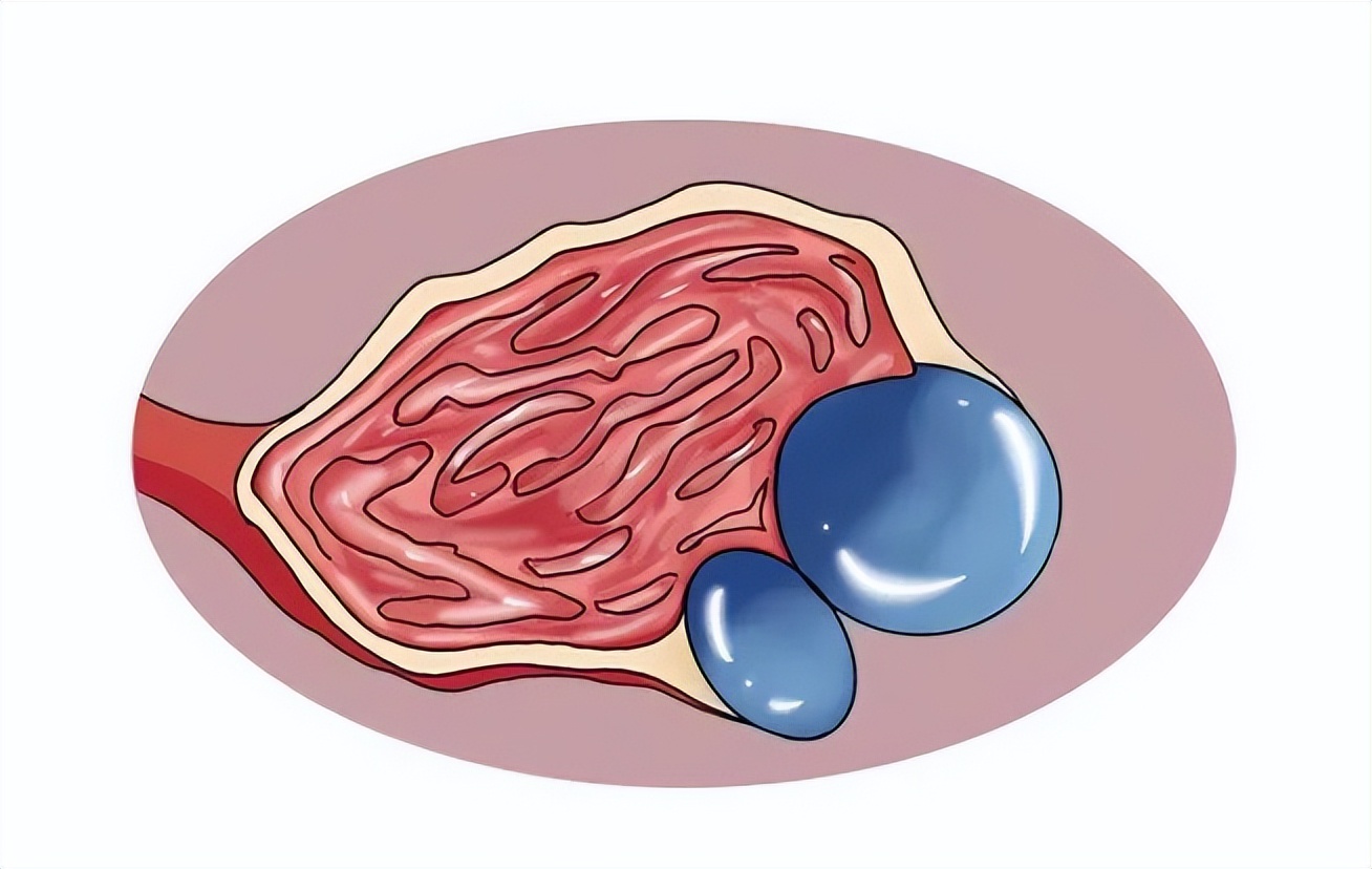 左卵巢巧克力囊肿影响生育吗,未婚女子卵巢囊肿影响生育吗