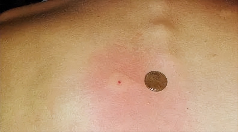 小宝宝出门怎么防护毒虫,带孩子出去玩当心这种虫子