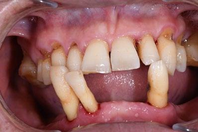 告别牙周炎的烦恼,告别牙痛