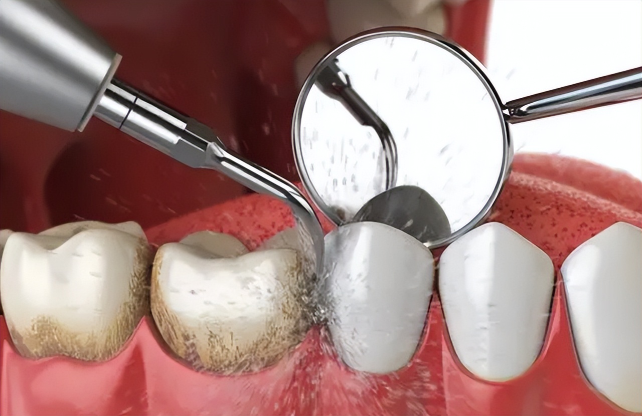 洗牙危害大还是不洗牙危害大,为什么有人说洗牙对牙齿有伤害啊