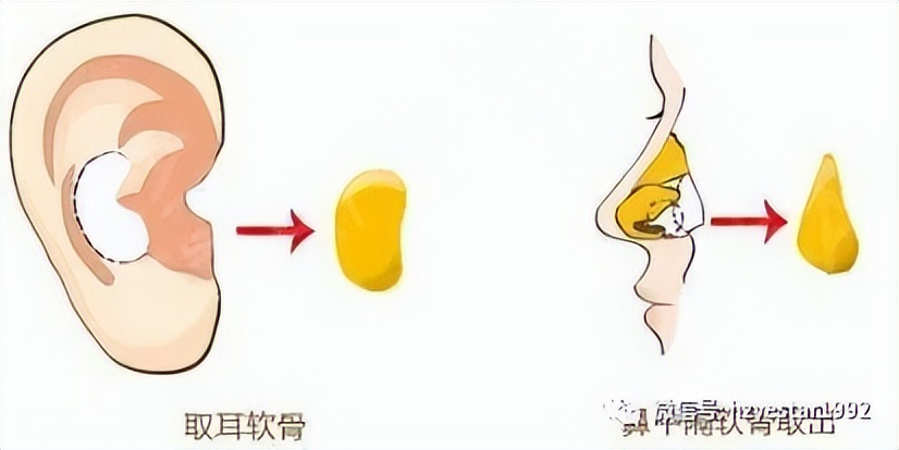 耳软骨隆鼻会塌下来吗,软骨隆鼻鼻小柱会塌吗