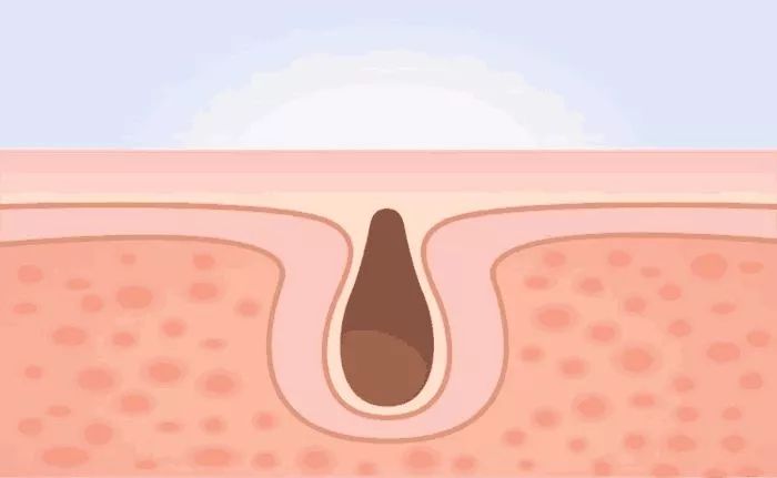 毛孔粗大的正确护肤步骤是什么,毛孔粗大护肤的正确步骤图