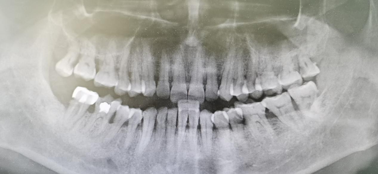 牙周炎引起牙齿松动一定要拔牙吗,牙周炎引起牙齿松动多久会掉