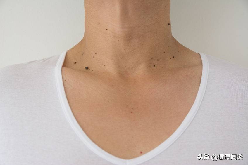 扁平疣很多简单有效的去除方法,扁平疣最不痛的去除方法