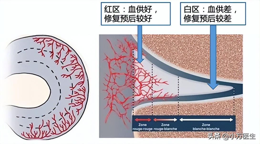 半月板后角撕裂微创手术,半月板撕裂分型