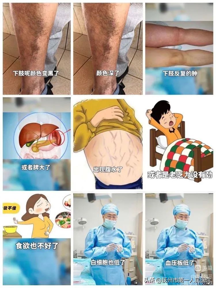 布加氏综合征介入治疗的注意事项,布加综合征介入手术加支架的利弊