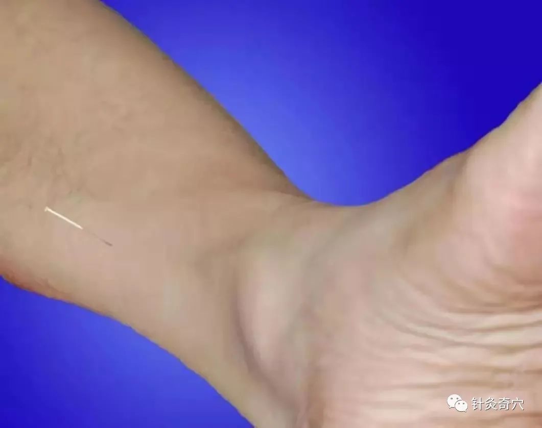 史上最全中医针灸视频教程全集,针灸治疗真实图片大全