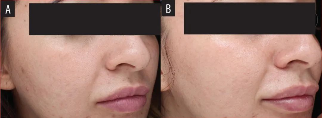 黄金微针能永久收毛孔吗,黄金微针是不是越肿效果越好