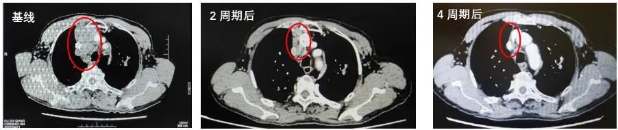 斯鲁利单抗治疗小细胞肺癌生存期,小细胞肺癌3a期用斯鲁利单抗