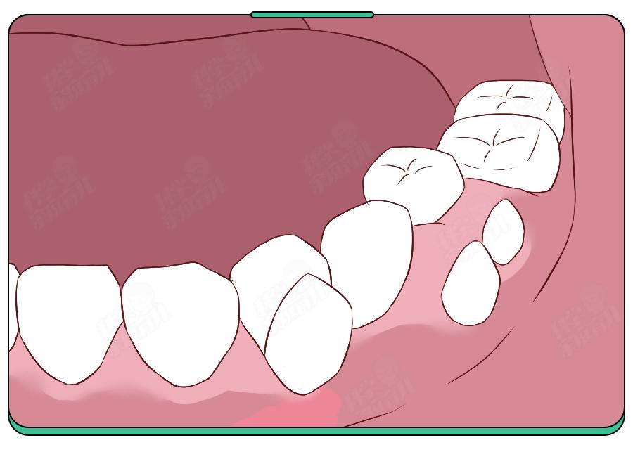 大牙基本都龋齿了怎么补救,新换的牙产生了龋齿怎么办