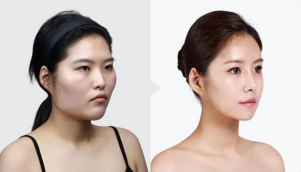 女子用臀部做了卧蚕,女人整容做卧蚕