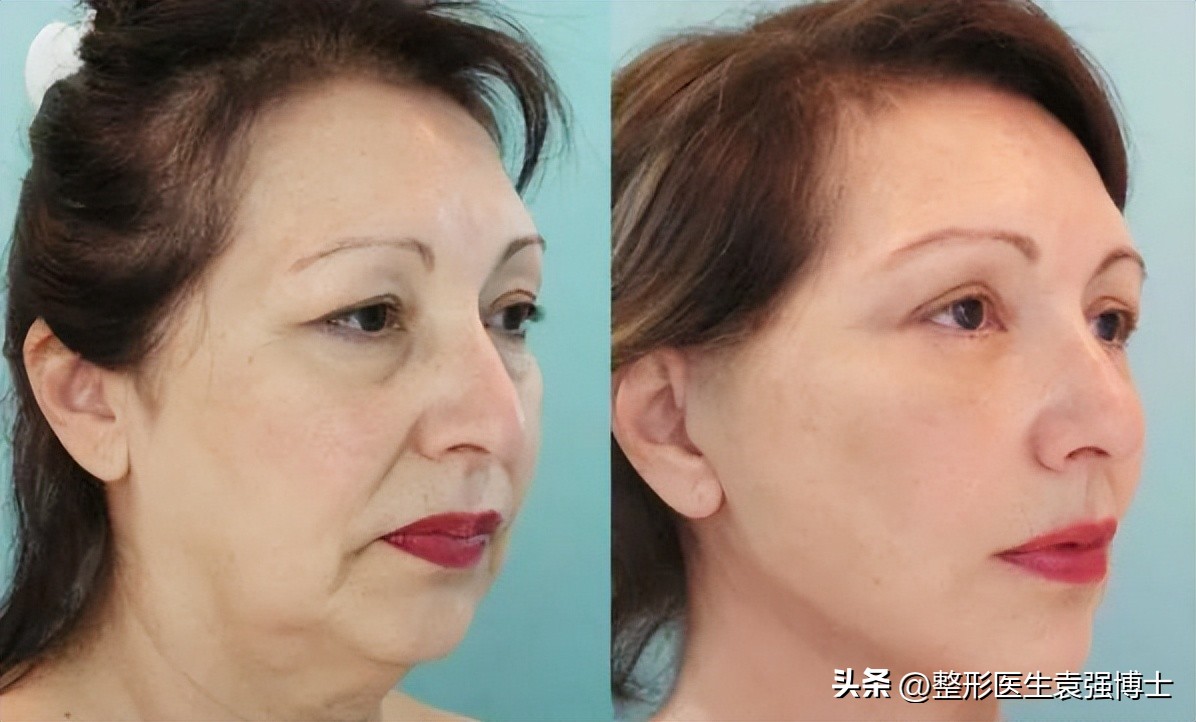 拉皮术后10年真实状态揭秘,拉皮手术后会经历的恢复阶段