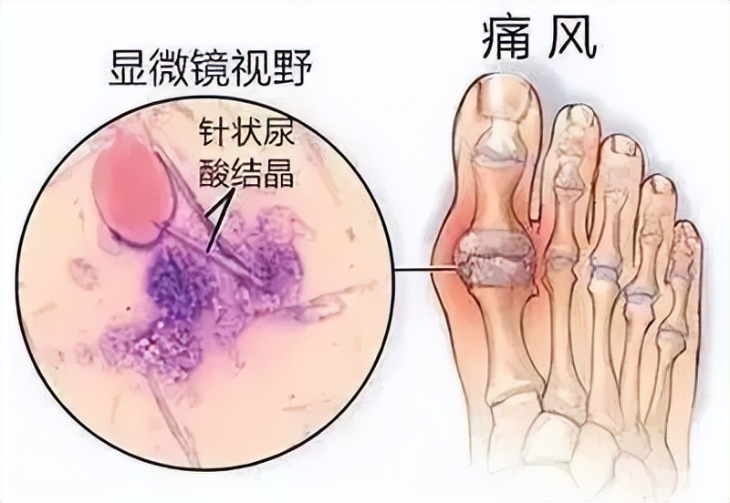 关节prp治疗要打麻药吗,风湿性关节炎prp