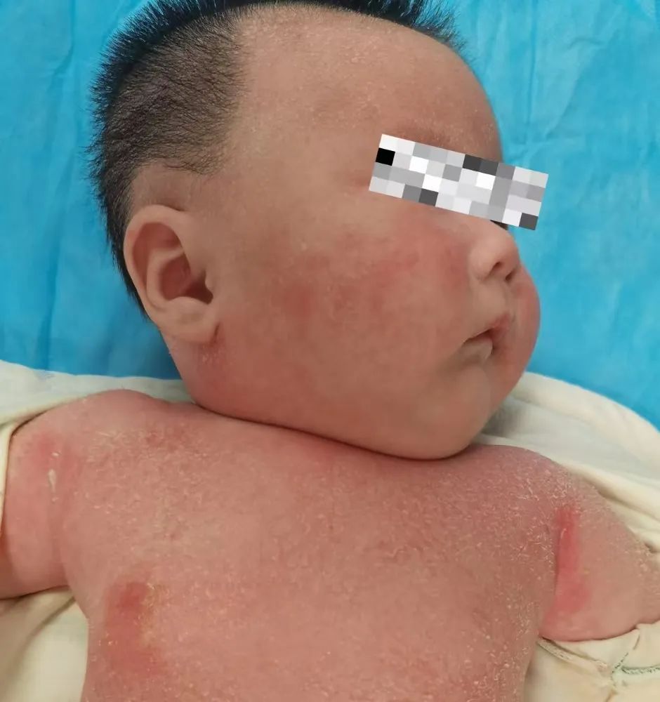 【解惑】孩子阳康1个月，皮疹咋还不消？