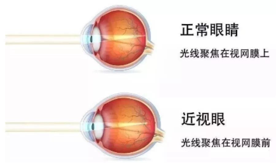 孩子眯眼后总是流泪,孩子眼睛怕光总是眯眼睛怎么治疗