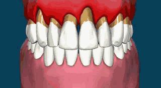 怎样让萎缩的牙龈重新长出来,牙龈萎缩还能长回去吗