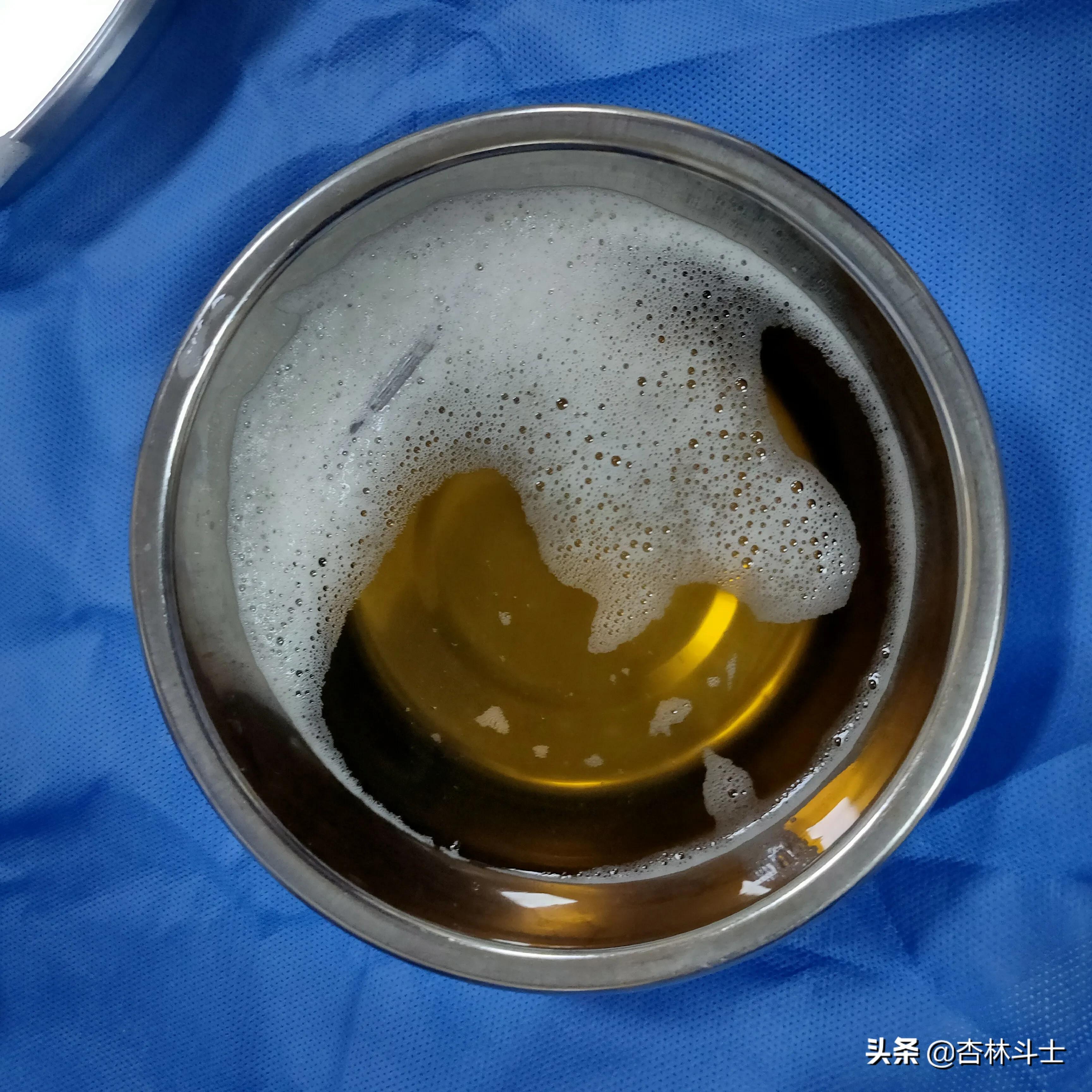64岁银行职员患肝囊肿，CT引导下细针穿刺抽吸酒精硬化解决大问题