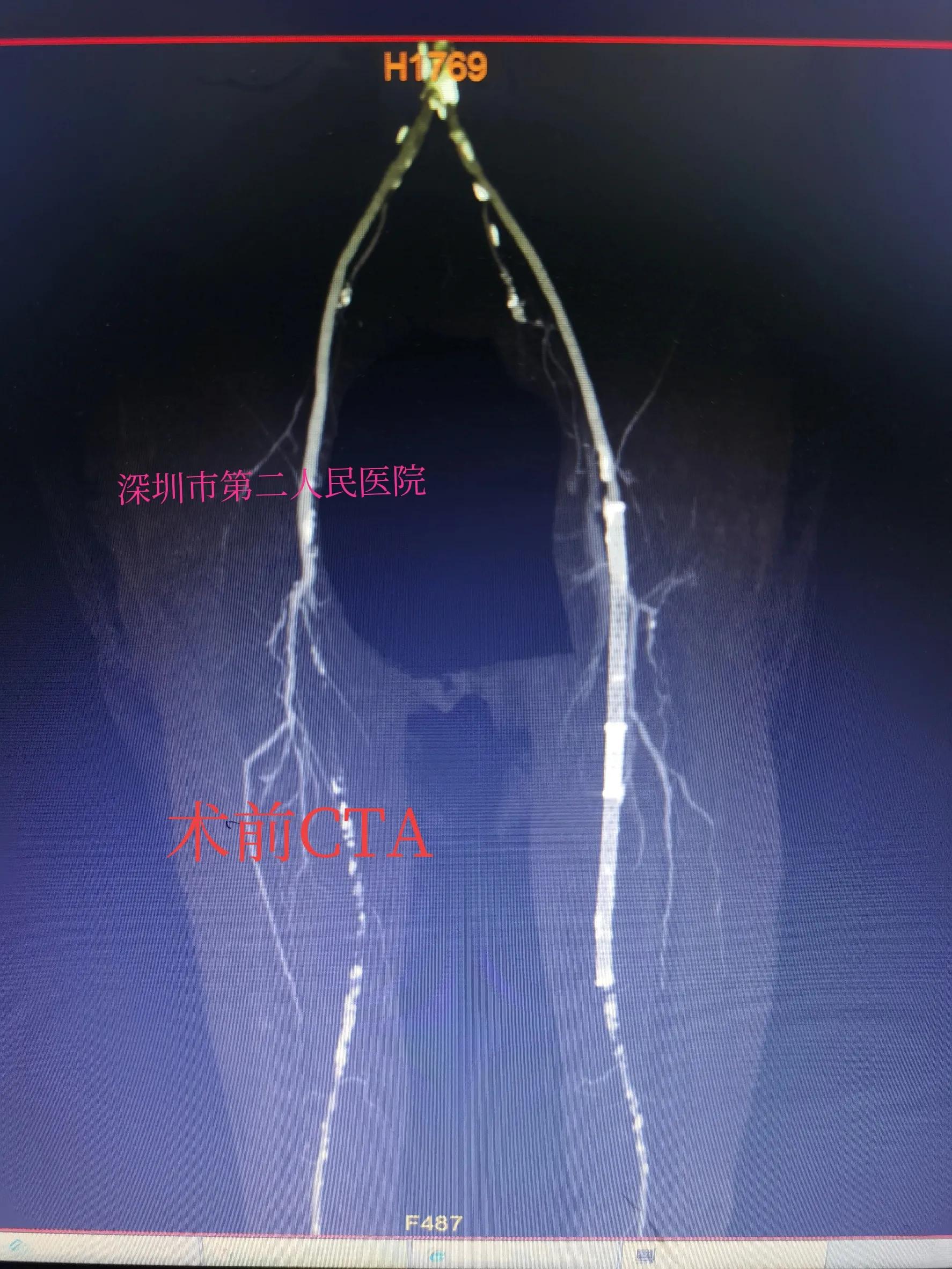 老年人小腿浮肿发紫什么原因,老人突然小腿发凉发软