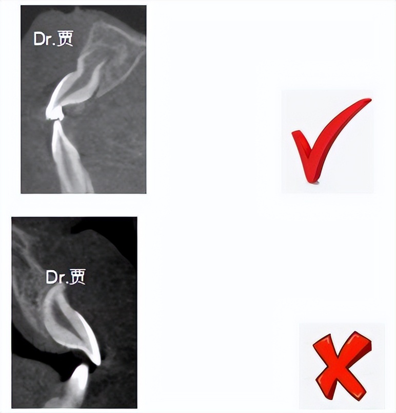 孩子门牙一直长不出来拍片子,儿童门牙一个不长需要看医生吗
