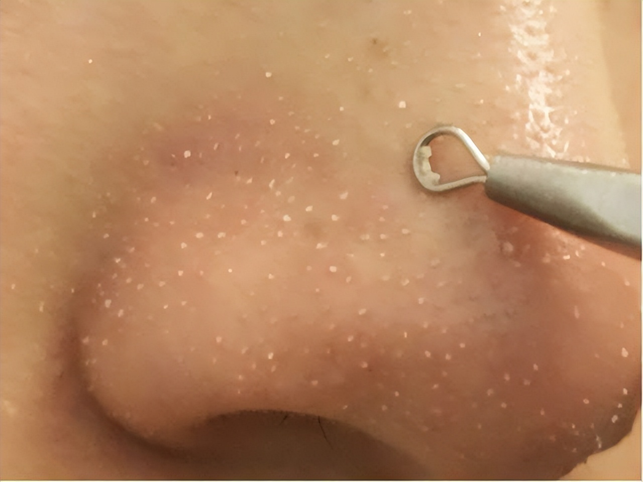 清洁面膜可以去黑头粉刺闭口吗,清洁面膜可以去除黑头吗