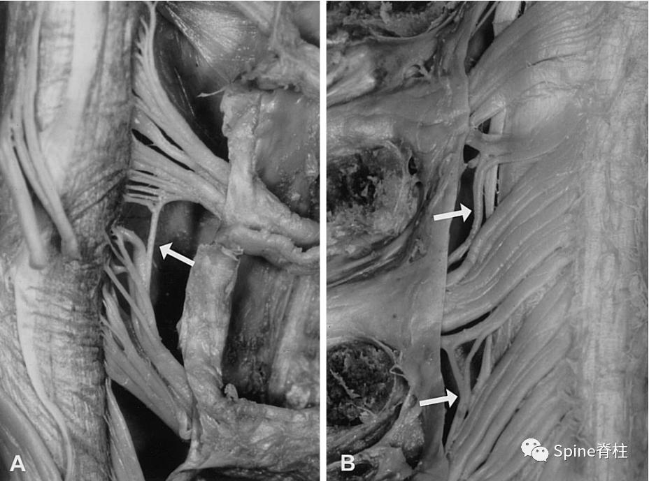 脊柱的神经支配,脊柱神经引起手臂疼痛