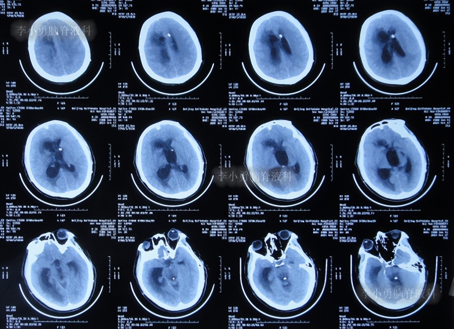 脑积水三脑室造瘘多久能恢复,脑囊虫手术后脑积水