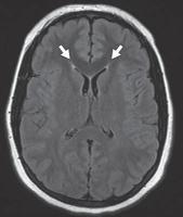 脑水肿的影像,脑水肿形成机制生理学