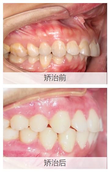 深覆合正畸适合戴隐适美吗,深覆合矫正能戴隐形牙套吗
