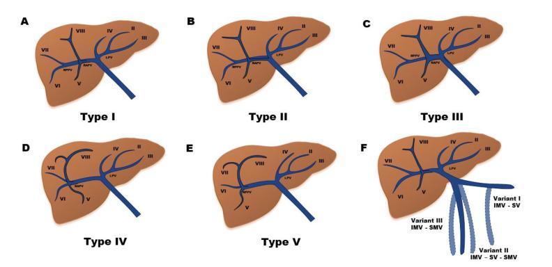 肝硬化伴有门静脉血栓介入治疗,肝硬化门脉血栓相关文章