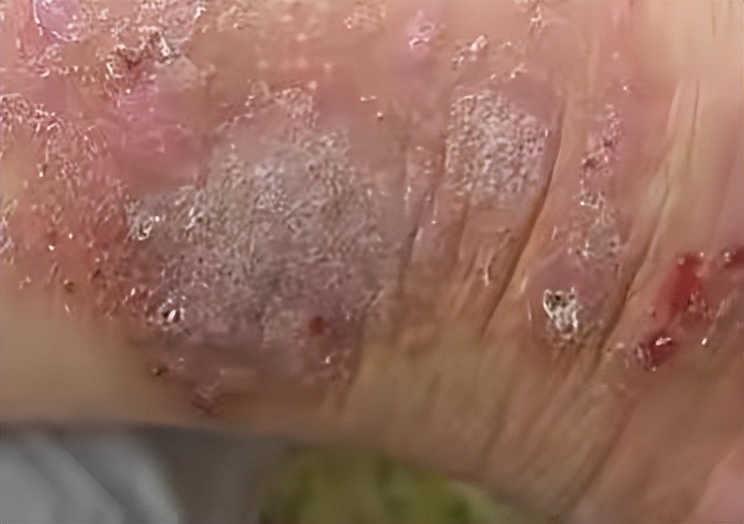 治疗湿疹，必先了解湿疹