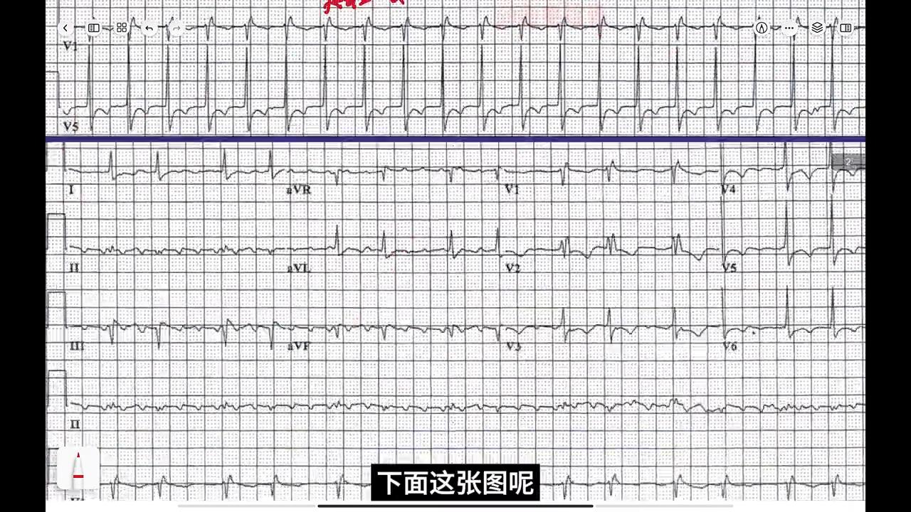 心电图病例分析-颈动脉窦受压改变房扑下传比例#执业医师考试
