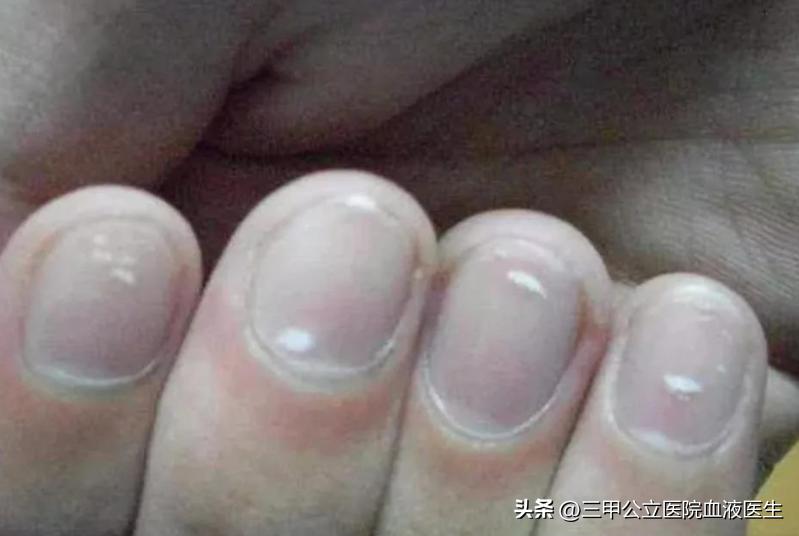 手指甲发白没有月牙有明显竖纹,手指甲有月牙和条纹是什么原因