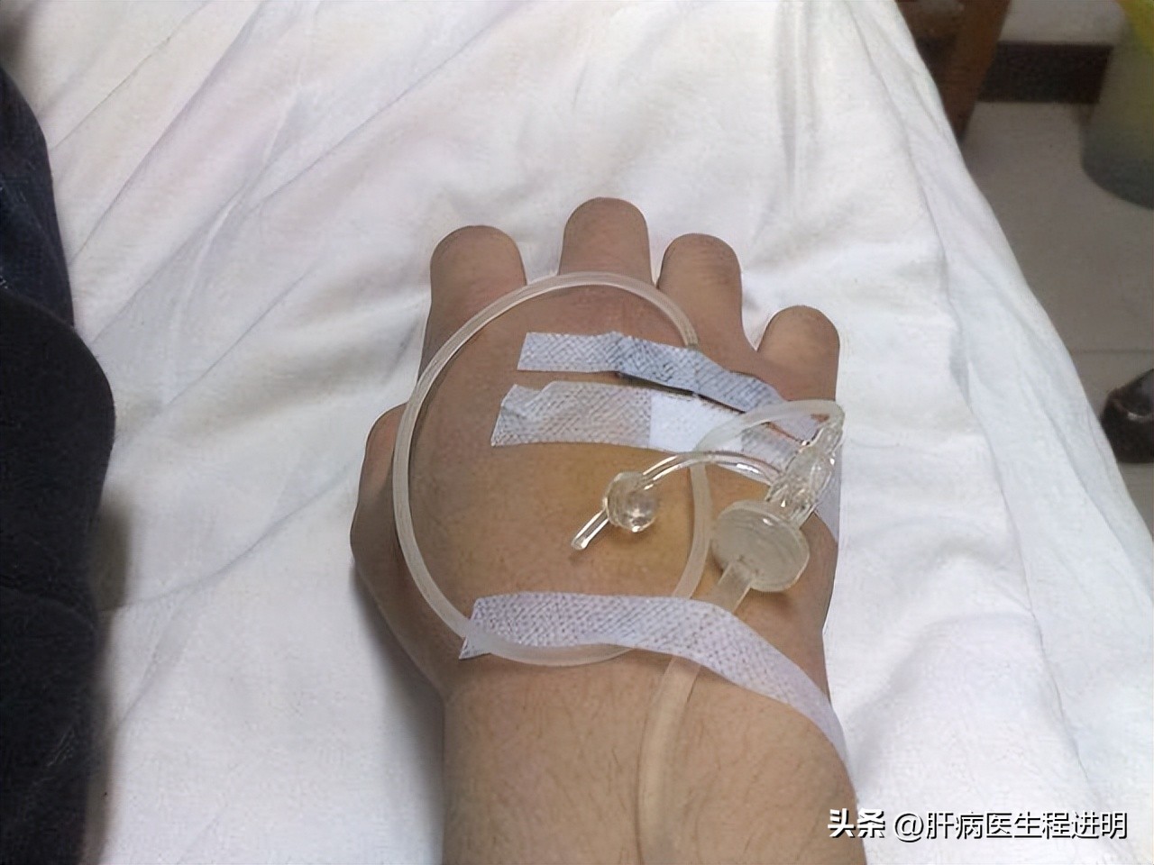 一位肝腹水患者的康复案例,我的肝硬化治疗经验分享