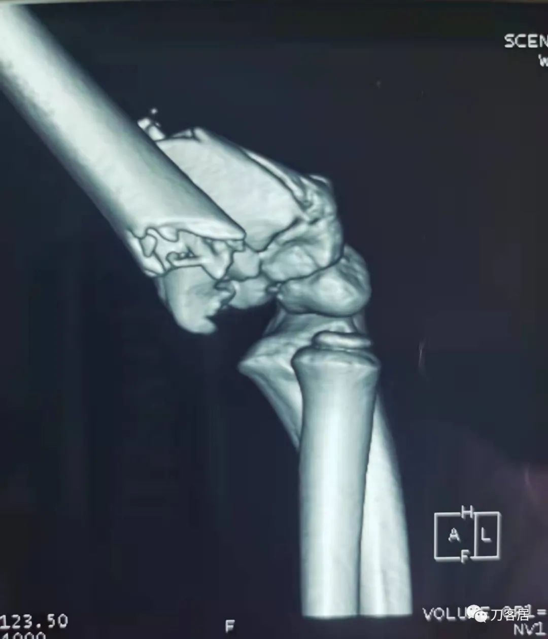 孩子胳膊摔伤肿了不能弯曲一直疼,9岁男孩摔倒手臂痛怎么办