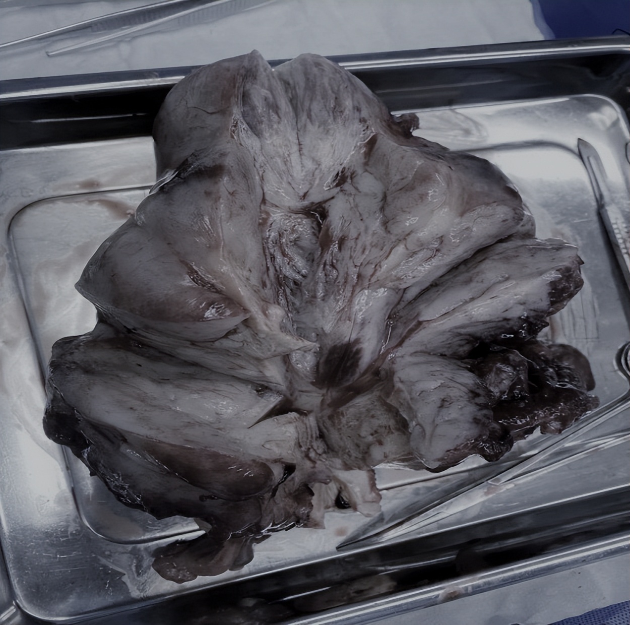 55岁女性绝经后突然来“月经”？原来是子宫淋巴瘤作祟