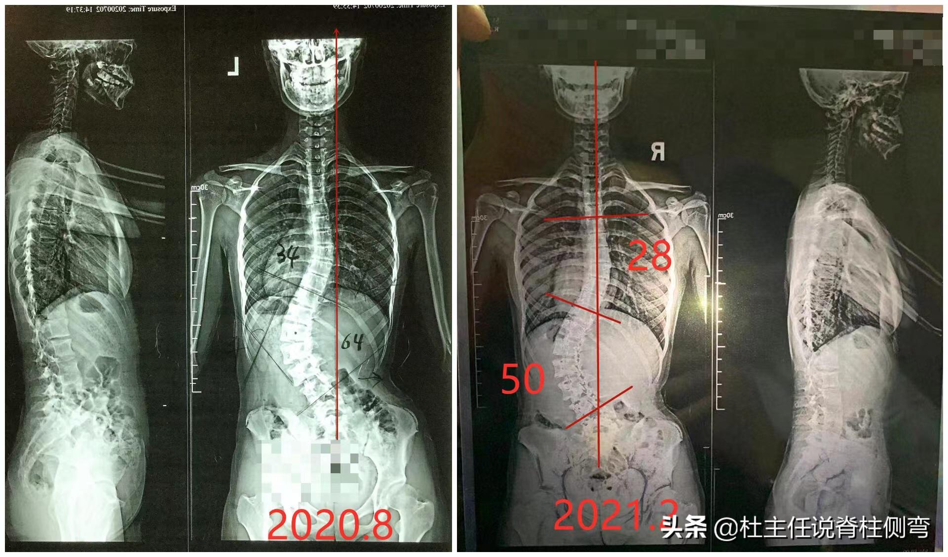 脊柱侧弯超过60度,还能选择保守治疗改善吗?恢复效果如何?