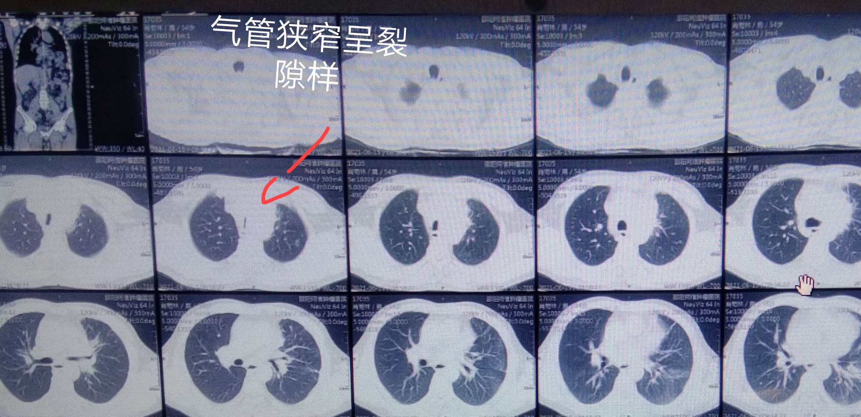 肿瘤压迫气管呼吸困难护理措施,肿瘤压迫气管呼吸困难怎么办