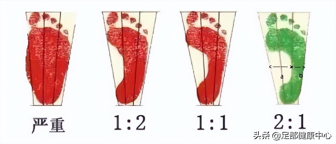 怎么判断扁平足严重程度,如何判断扁平足