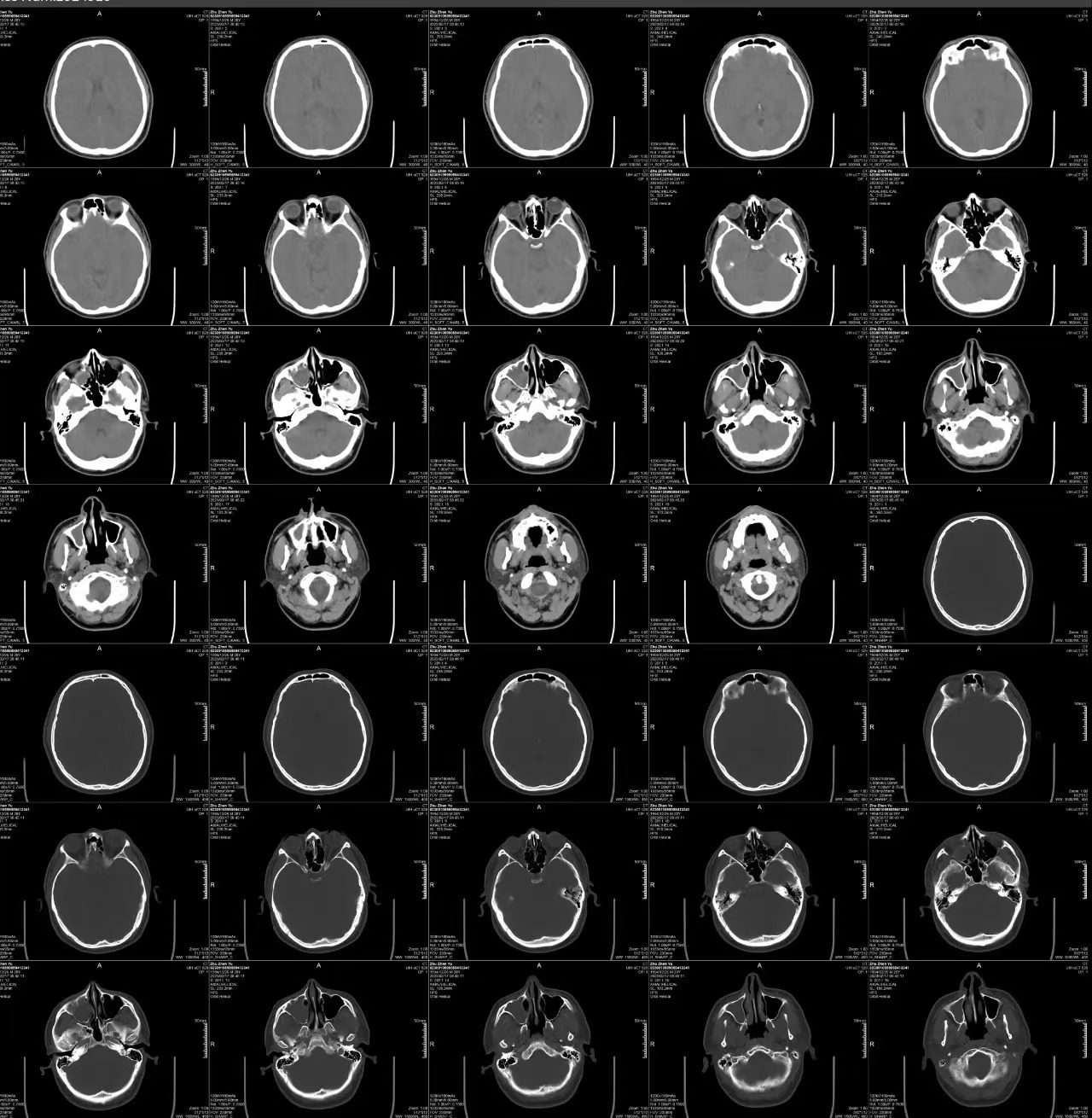 有没有治鼻涕倒流的偏方,鼻涕倒流正确治疗方法中医