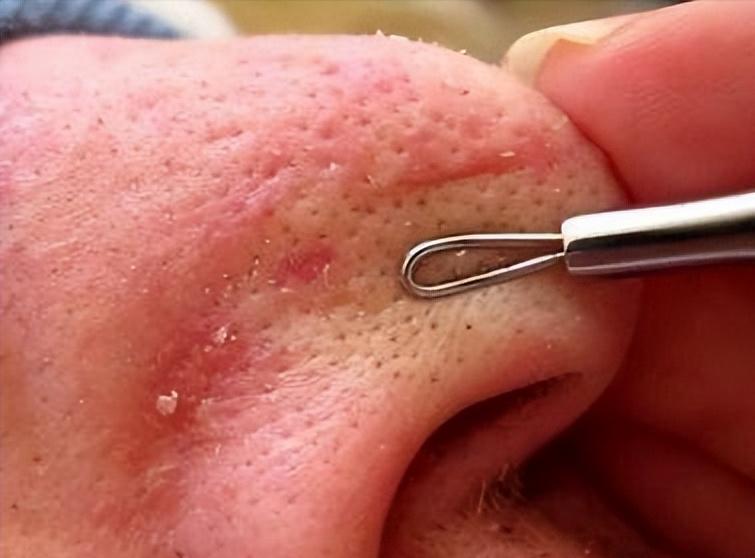 鼻子上有黑点怎么抠掉,鼻子边缘的小白点怎么去除