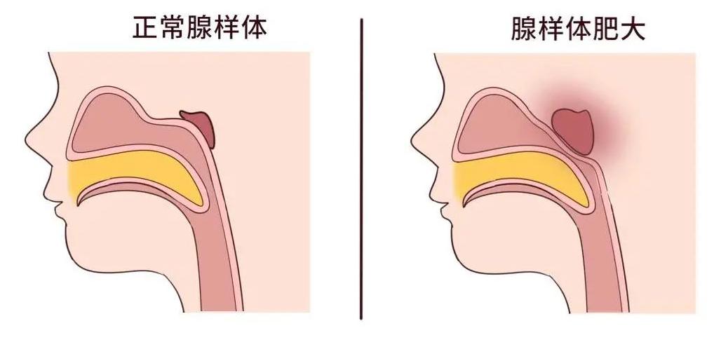 4岁女孩腺样体肥大不做手术，自拟银黄双解汤，腺样体明显回缩！