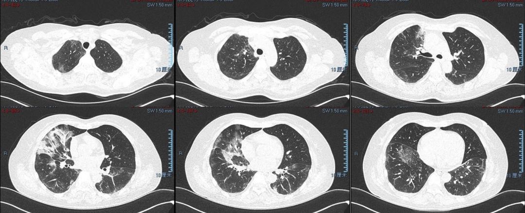 新冠感染第5天病情一直反复,新冠感染后病情历程