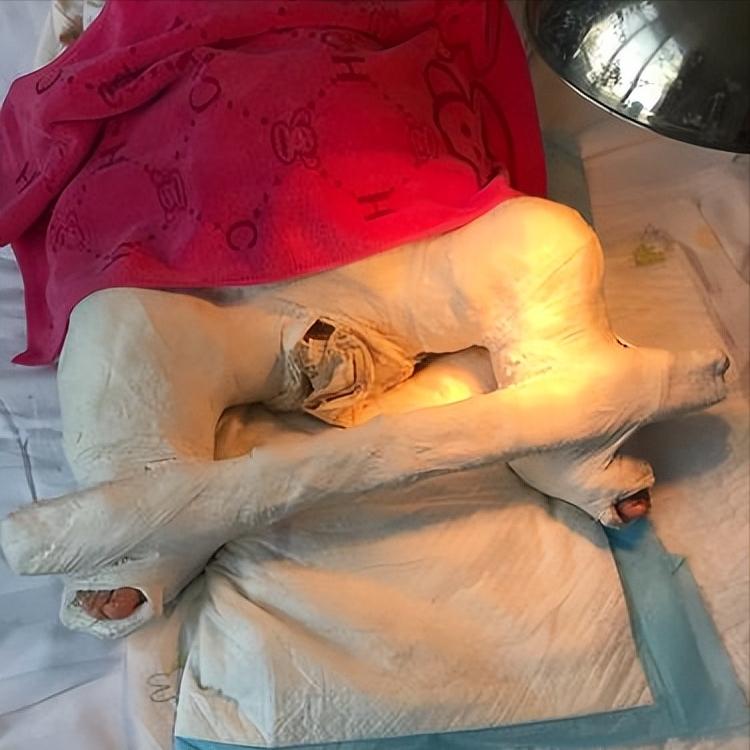 儿童股骨干粉碎性骨折对位不太好,儿童股骨干骨折石膏固定