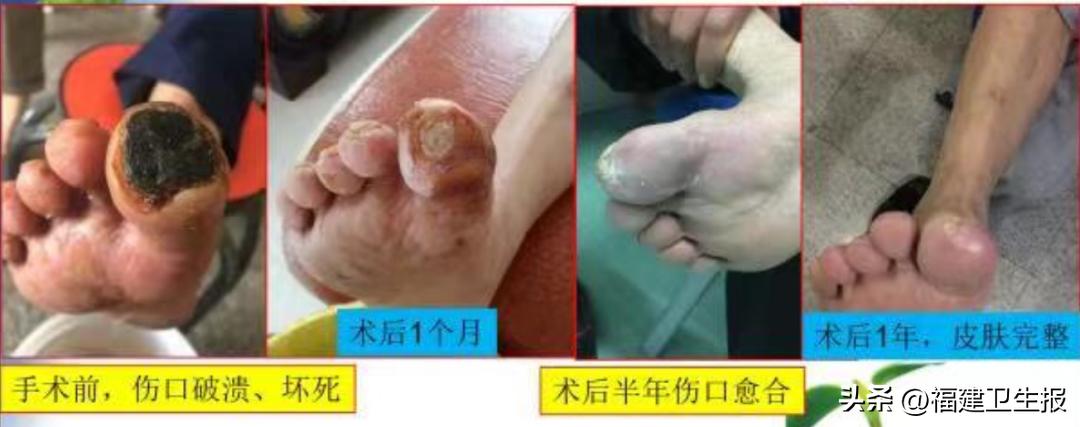 福州60岁老伯，出现脚趾发黑，险些截肢！专家：其实是血管堵住了
