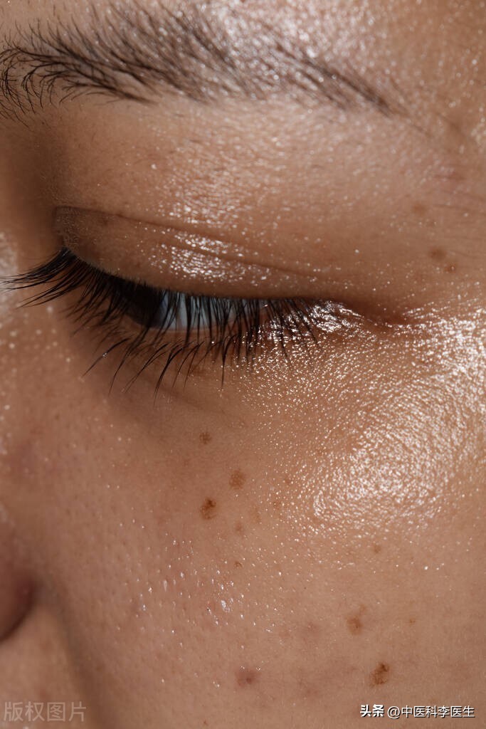 雀斑黄褐斑老年斑晒斑怎么区分,褐斑老年斑怎么治疗效果最好