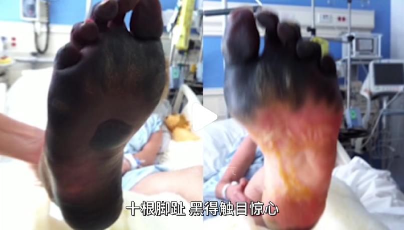 超模用卫生棉条感染截肢励志,一名超模因卫生棉截肢