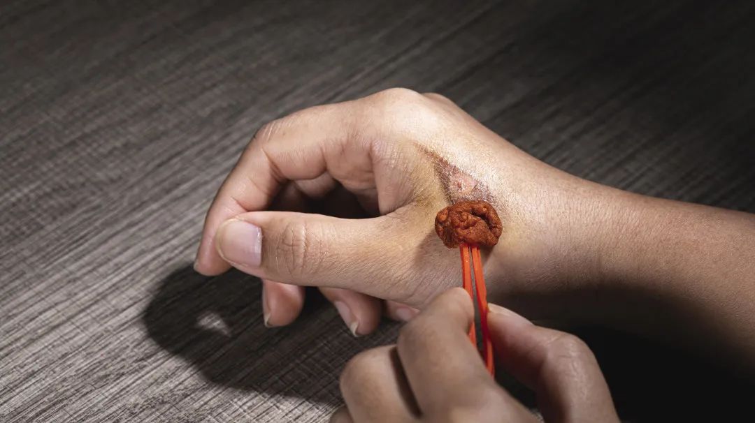 乳腺癌放疗会伤害气管吗,乳腺癌放疗后臂丛神经损伤怎么办