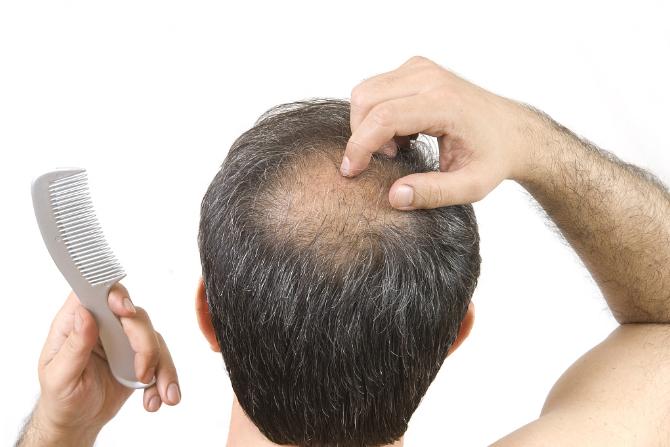 脱发的位置不同原因有区别吗,只有一个地方脱发严重是为什么